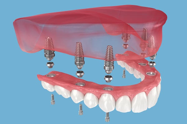 Do All On ® Implants Look Natural?